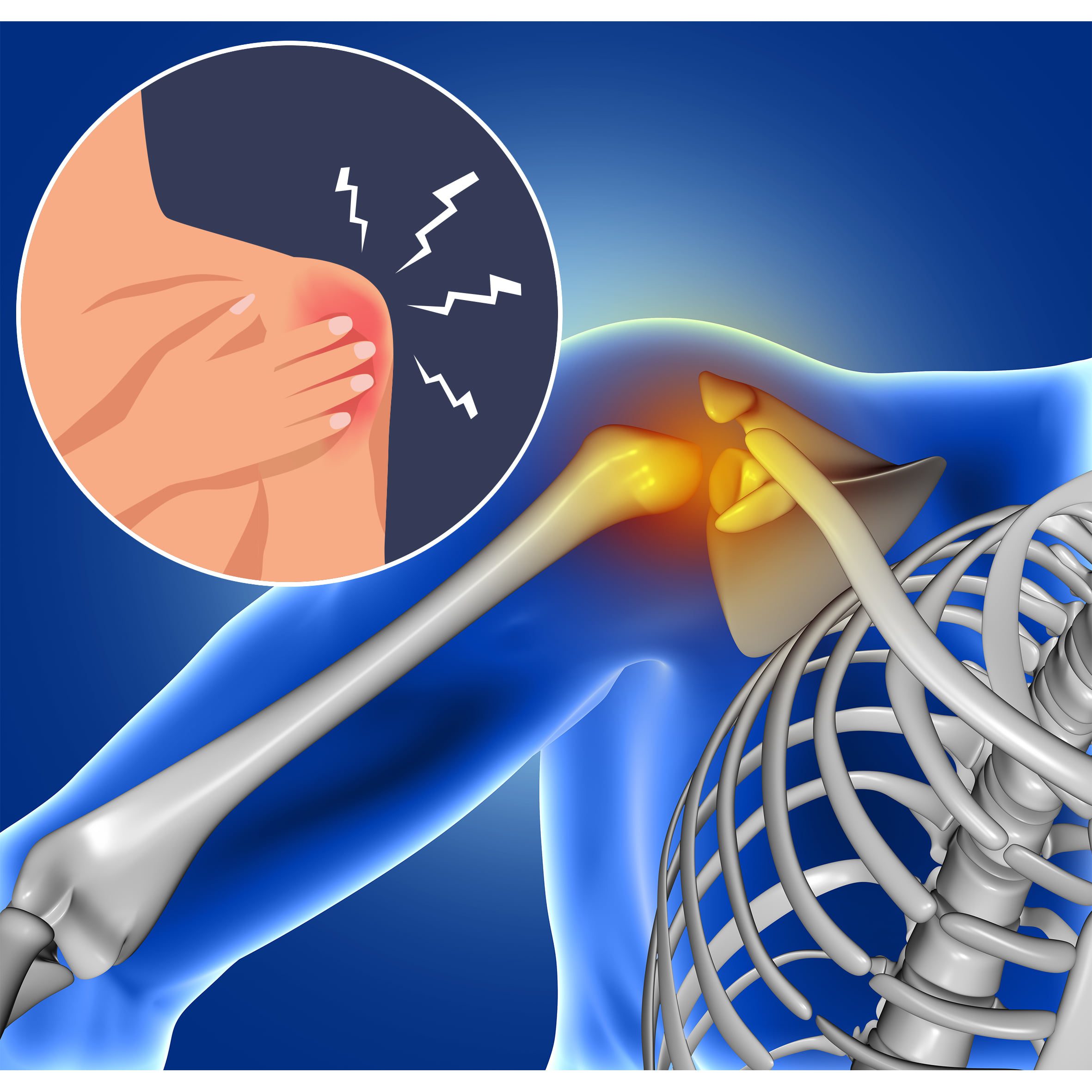 Calcium Deposits in Shoulder Natural Remedies