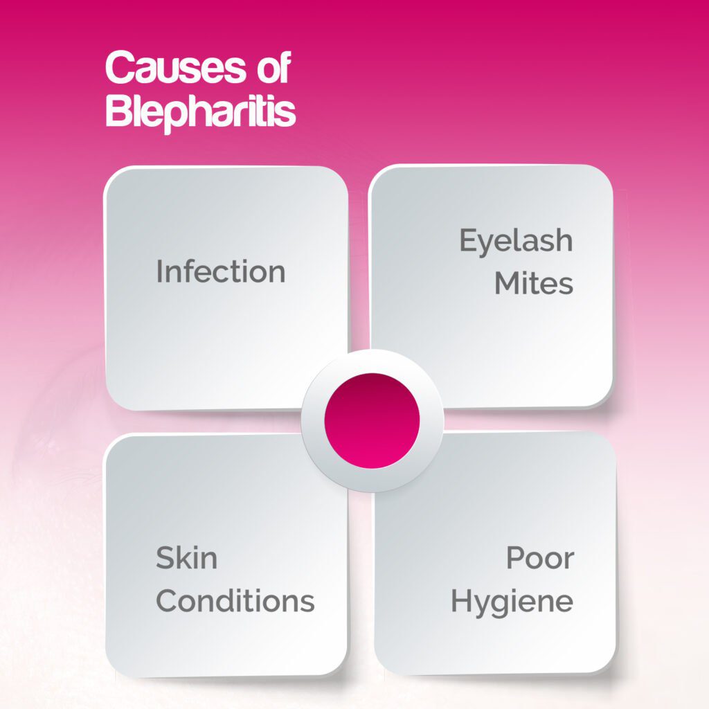 Causes of Blepharitis