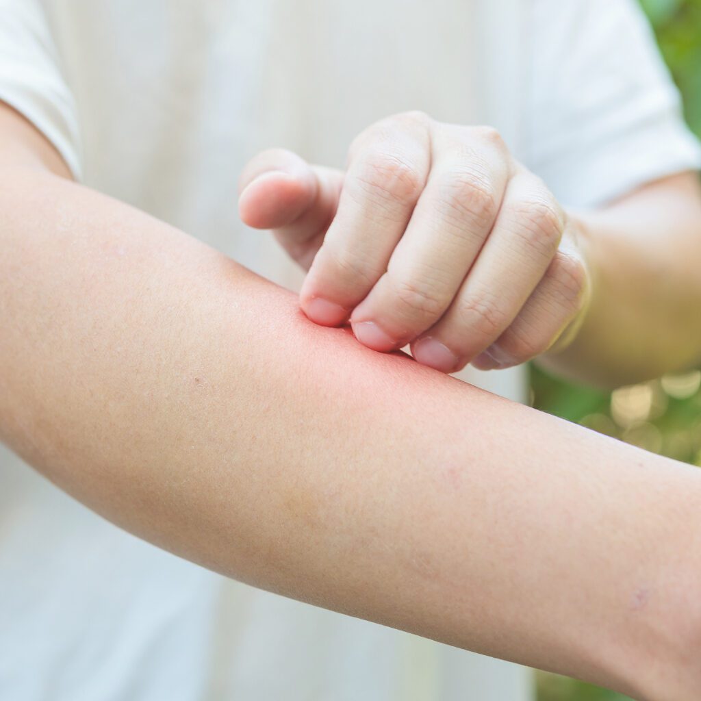 Insect Sting Allergies