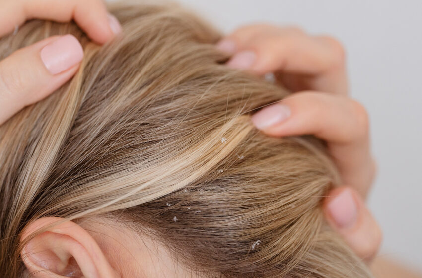  7 Home Remedies To Get Rid of Dandruff and Oily Scalp