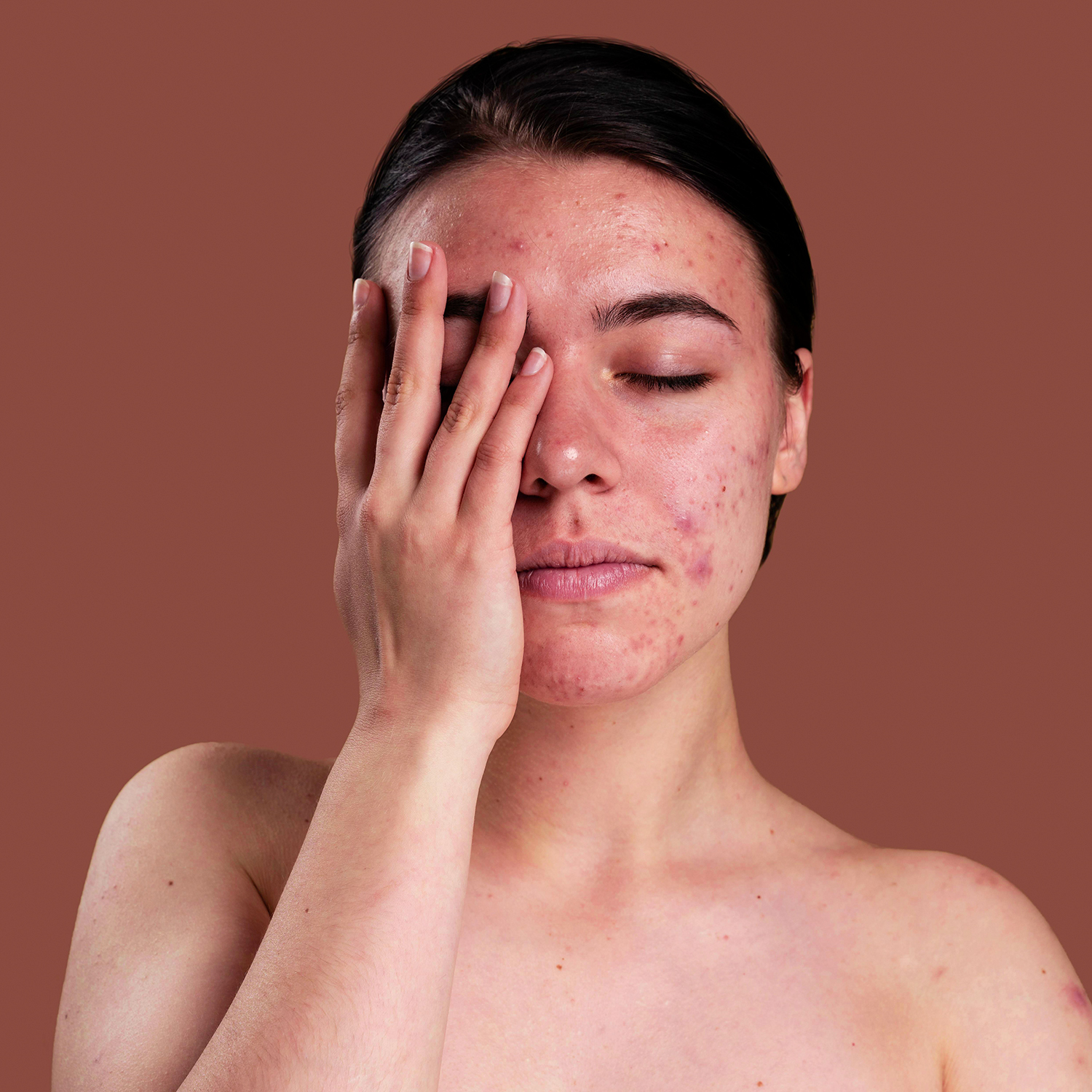 6 Natural Ways Of Getting Rid Of Pimples