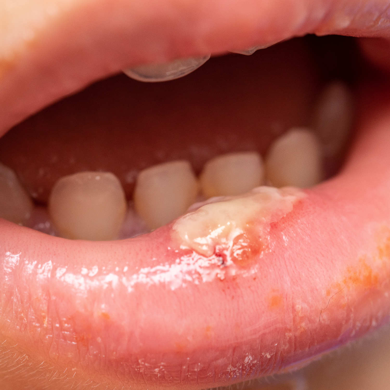 10 Best Home Remedy For Mouth Ulcer