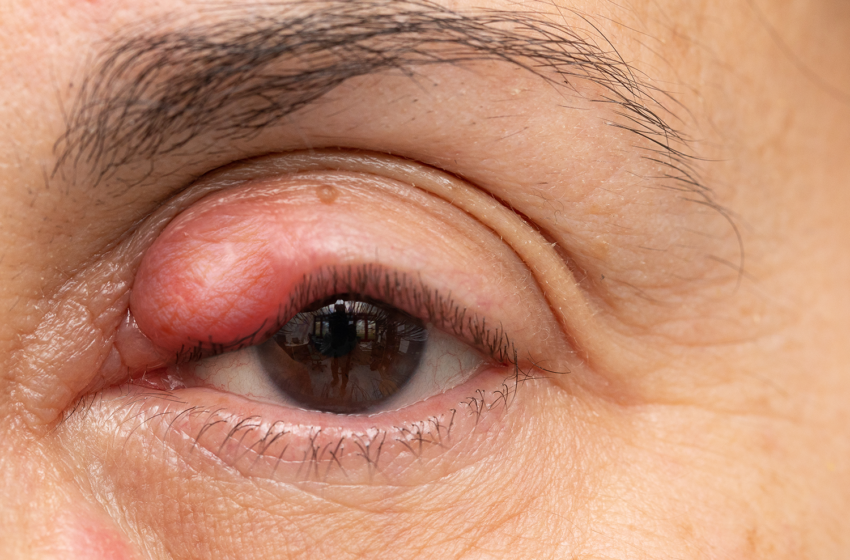  8 Amazing Home Remedies To Get Rid Of A Stye