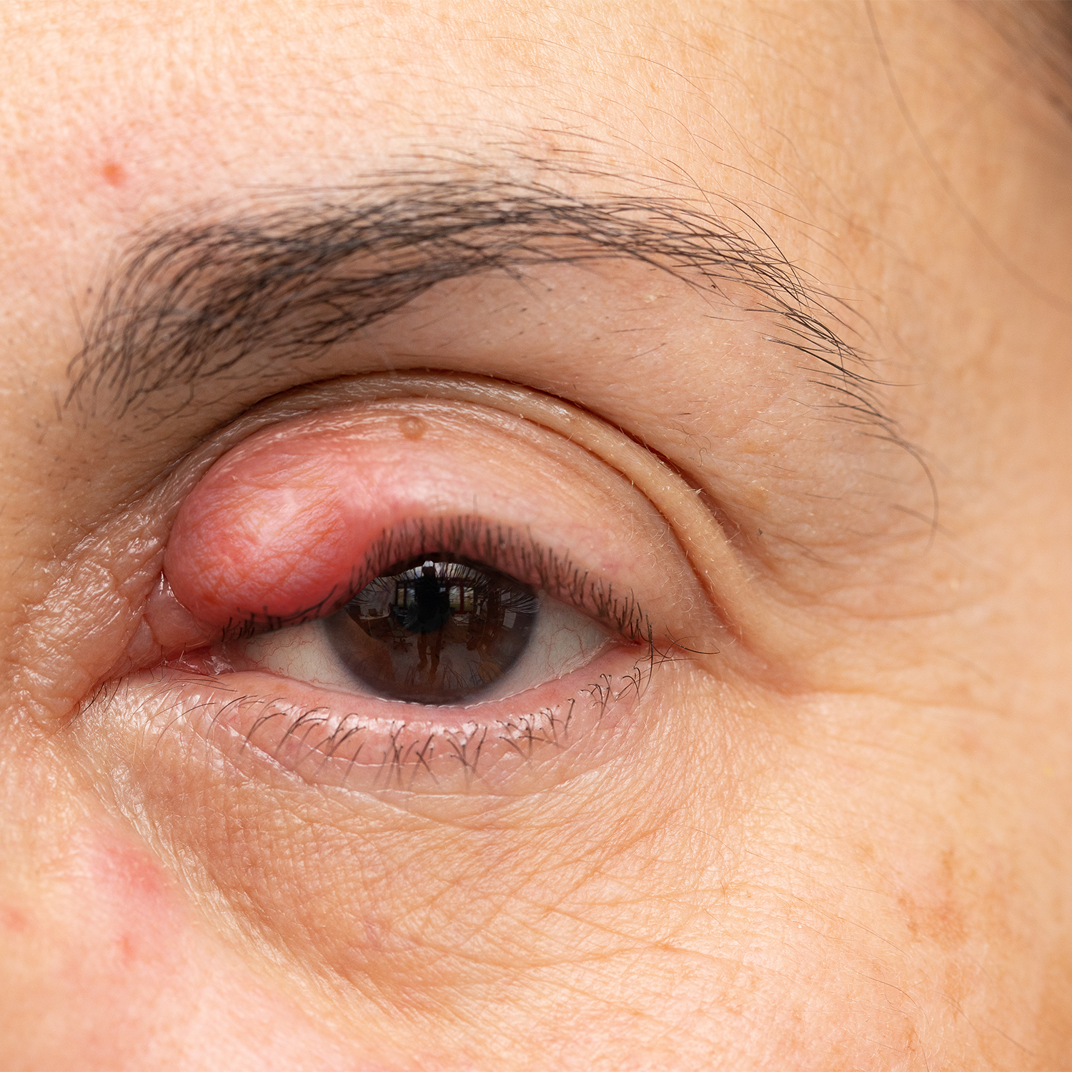 8 Amazing Home Remedies To Get Rid Of A Stye