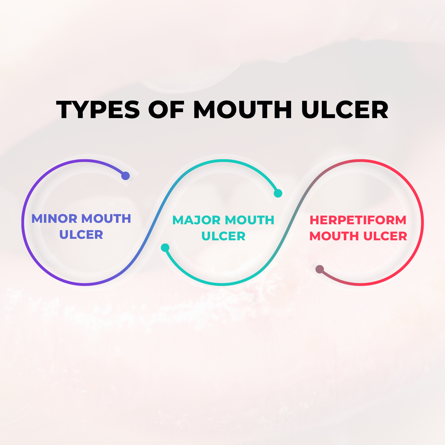 Types of Mouth Ulcers
