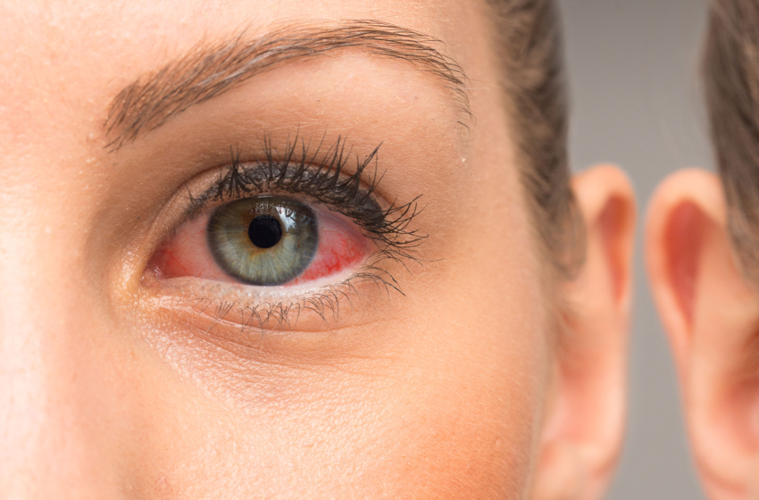  8 Great Home Remedies For Eye Infection
