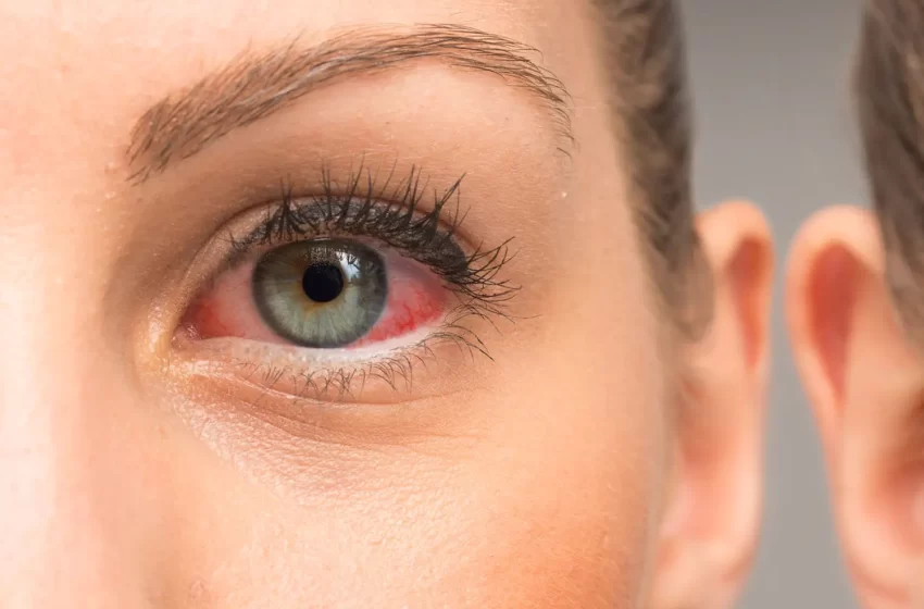  8 Great Home Remedies For Eye Infection