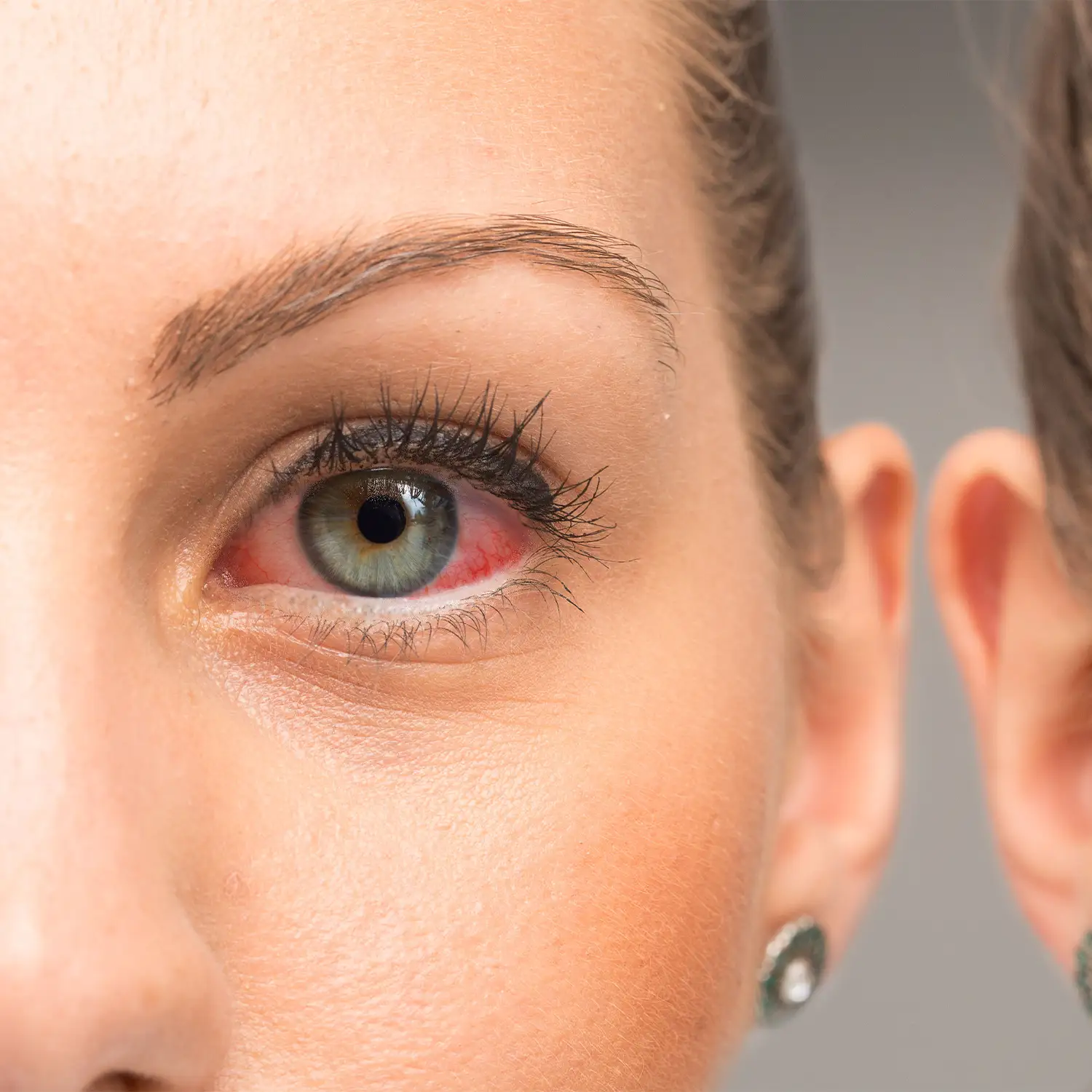 8 Great Home Remedies For Eye Infection