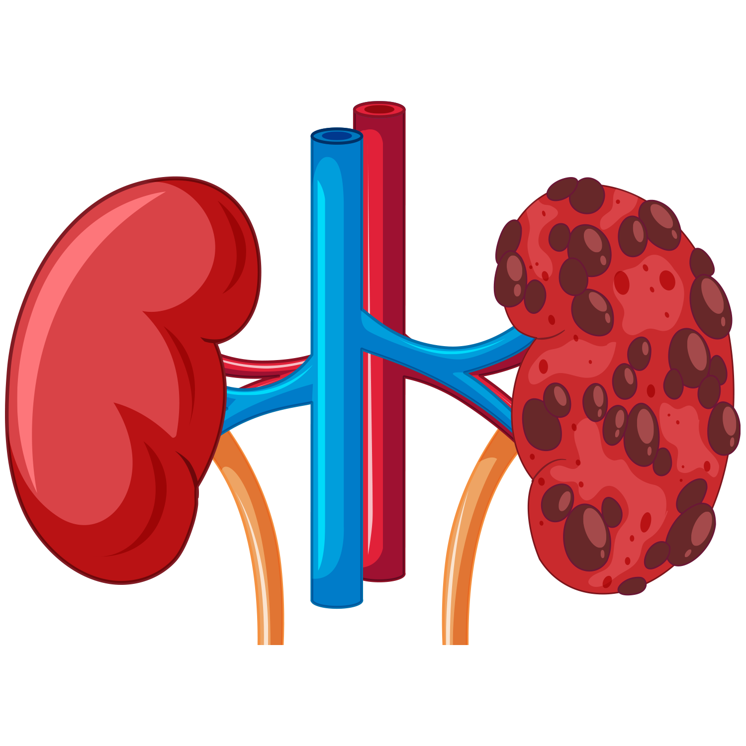 Natural Remedies For Kidney Diseases
