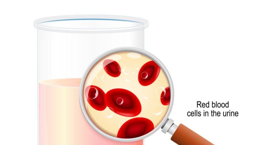hematuria-blood in urine