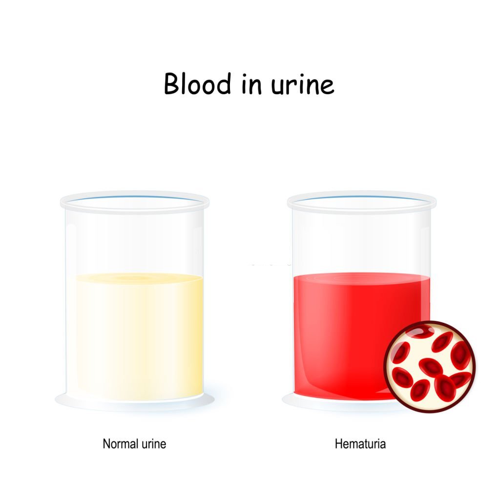 comparison between normal urine and hemturia