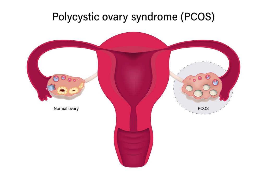 comparison between PCOS and normal ovary