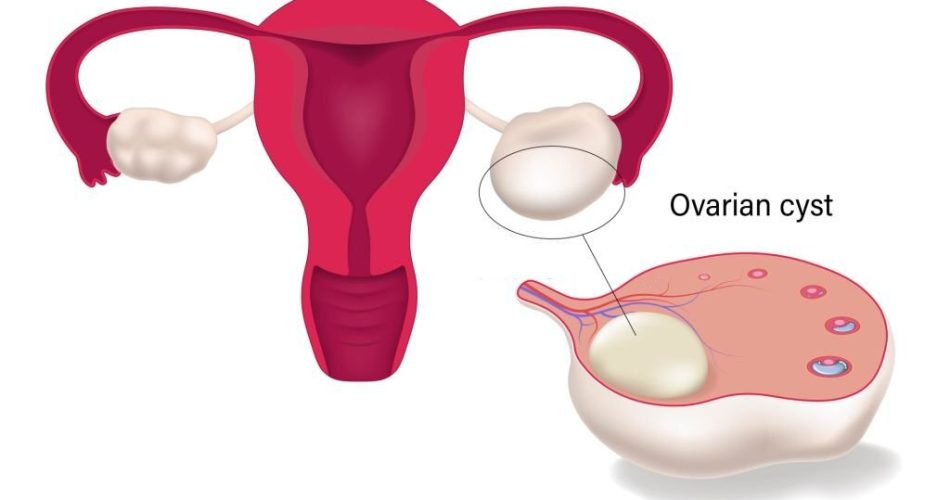 Ovarian cyst. Female reproductive system. Human uterus.
